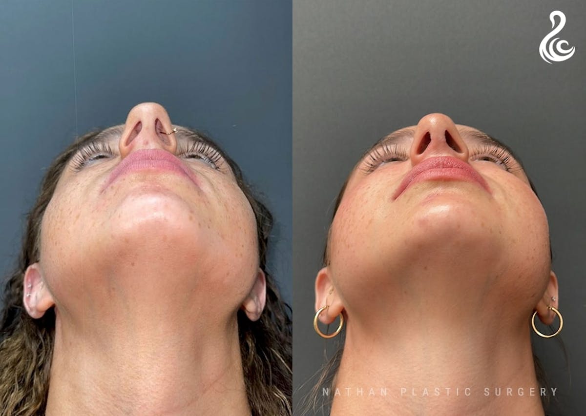 Rhinoplasty Before & After Gallery - Patient 223197 - Image 6