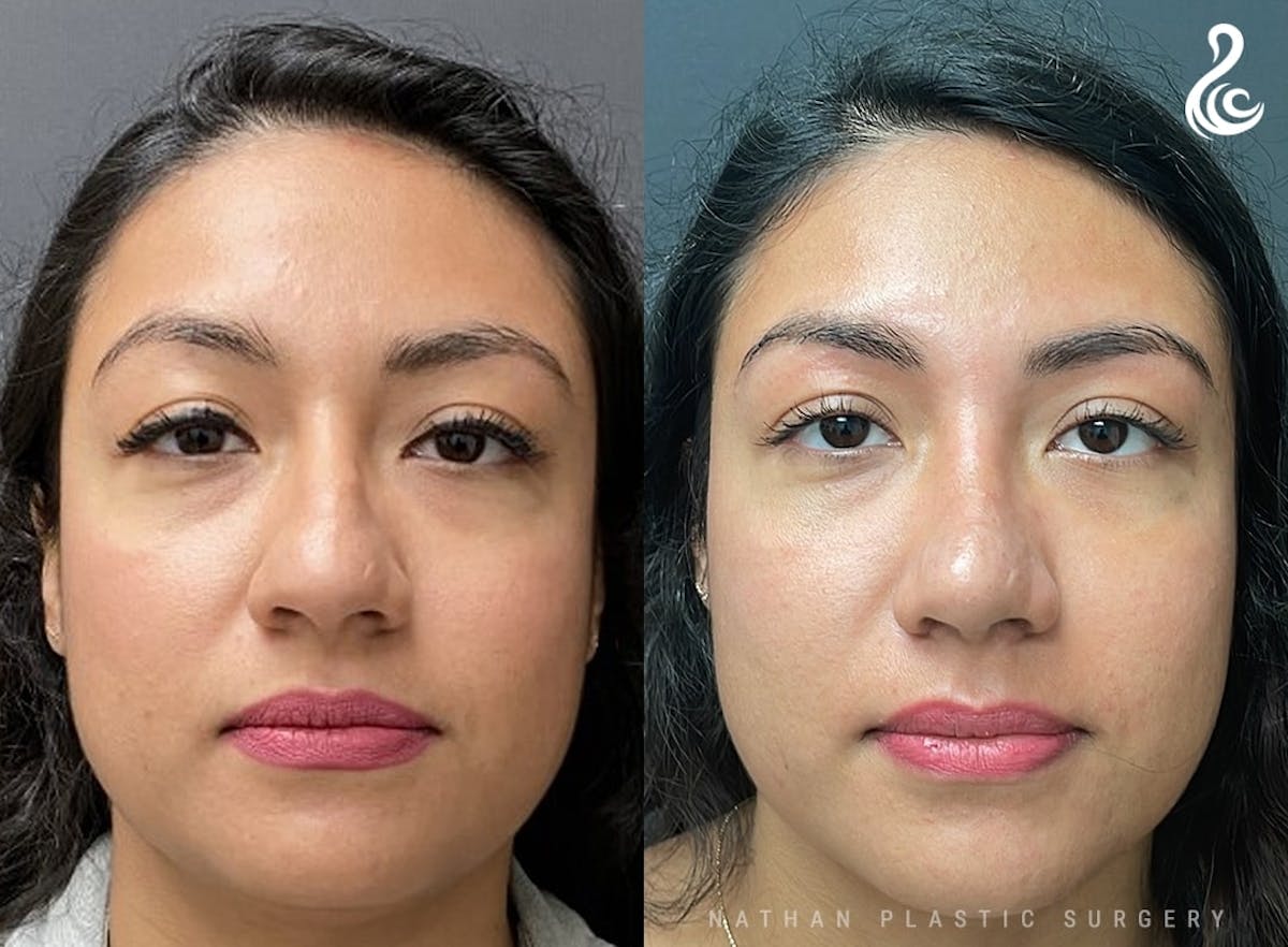 Rhinoplasty Before & After Gallery - Patient 104313 - Image 3