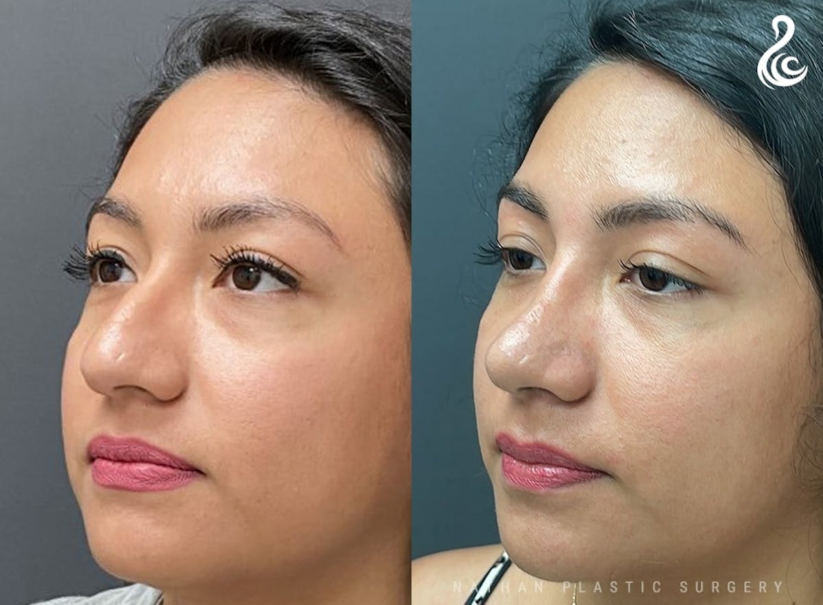 Rhinoplasty Before & After Gallery - Patient 104313 - Image 4