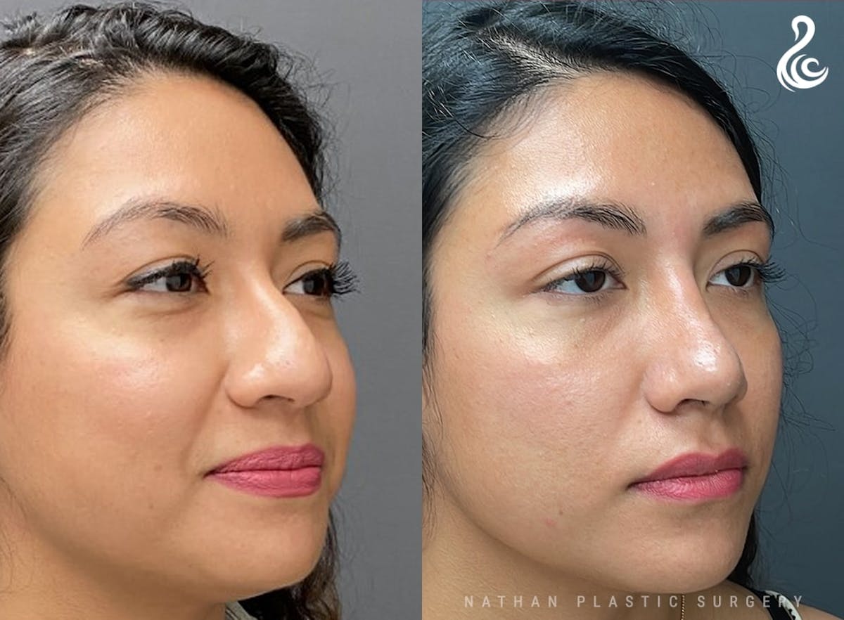 Rhinoplasty Before & After Gallery - Patient 104313 - Image 5