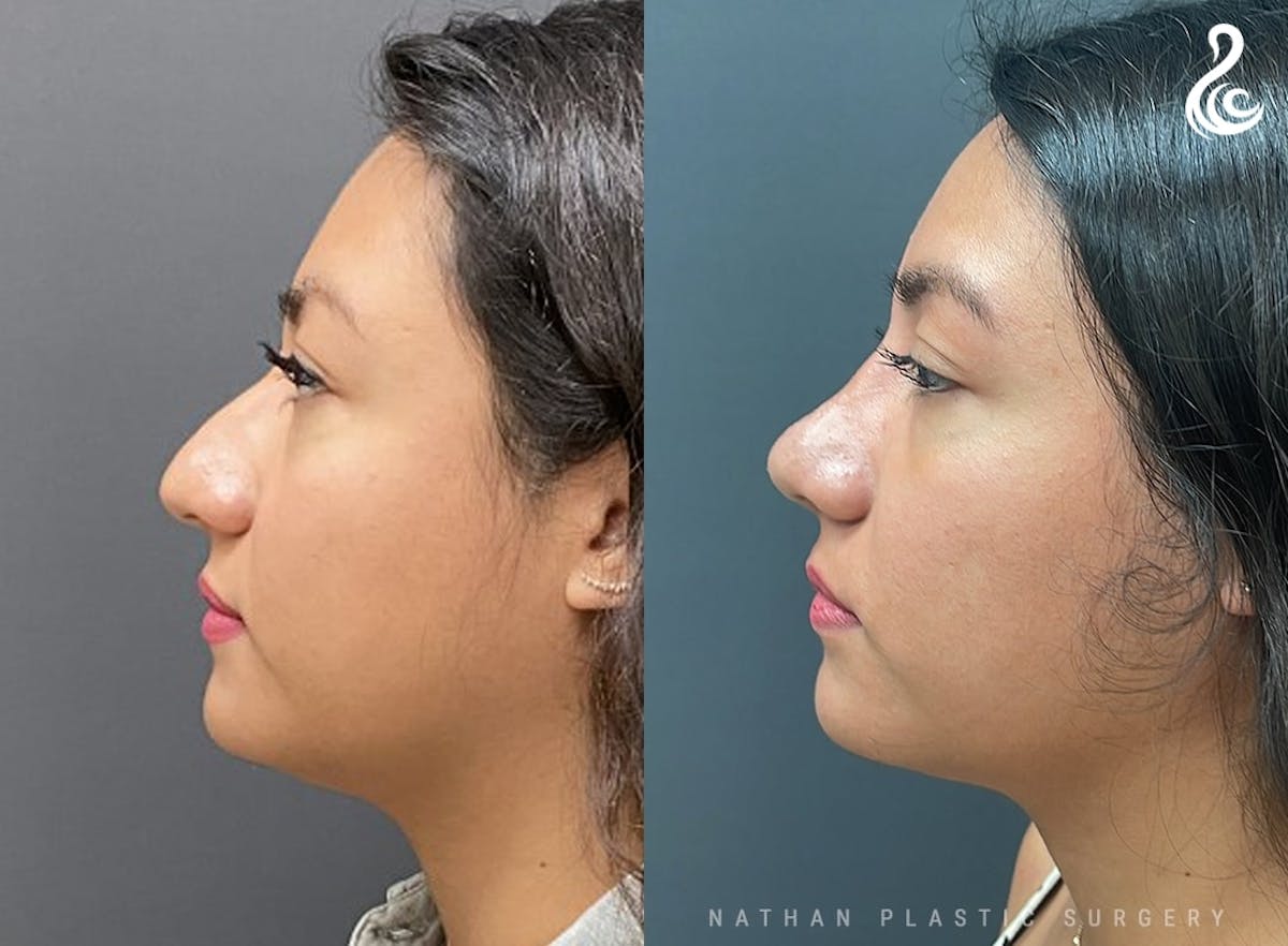 Rhinoplasty Before & After Gallery - Patient 104313 - Image 1