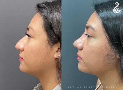 Rhinoplasty Before & After Gallery - Patient 104313 - Image 1