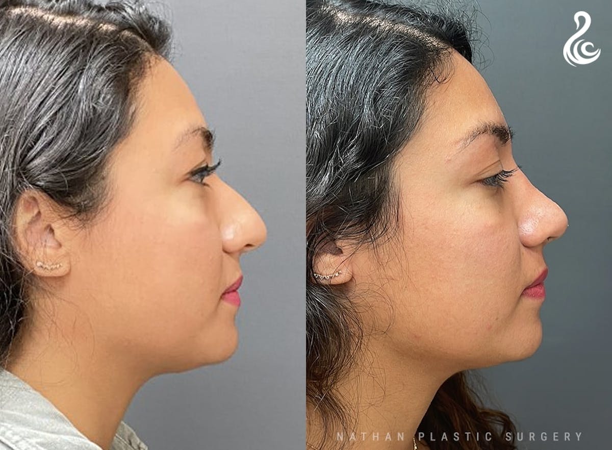 Rhinoplasty Before & After Gallery - Patient 104313 - Image 2