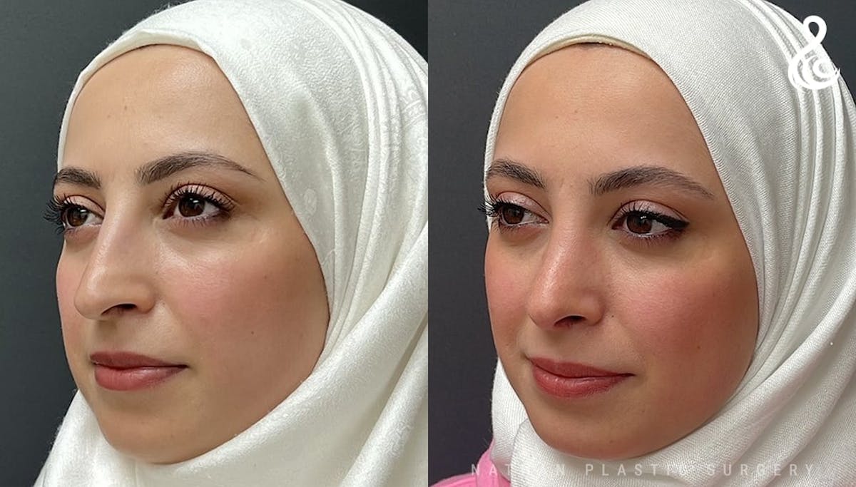 Rhinoplasty Before & After Gallery - Patient 308205 - Image 4