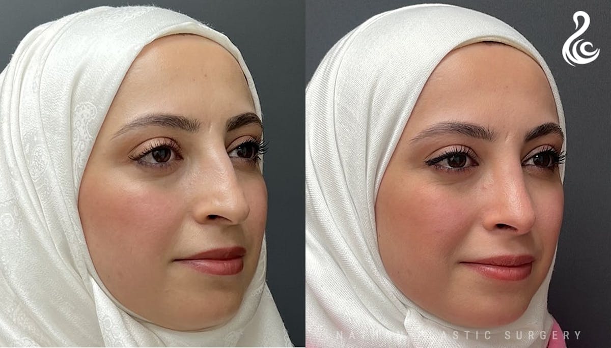 Rhinoplasty Before & After Gallery - Patient 308205 - Image 5