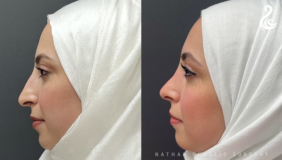 Rhinoplasty Before & After Gallery - Patient 308205 - Image 1