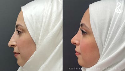 Rhinoplasty Before & After Gallery - Patient 308205 - Image 1