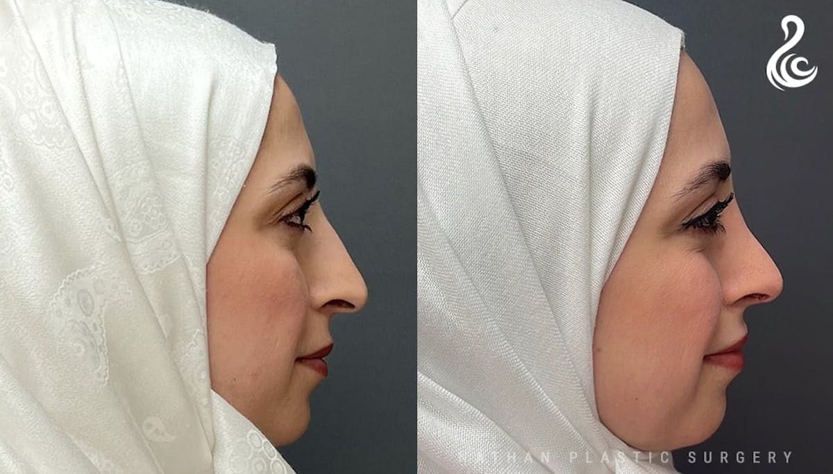 Rhinoplasty Before & After Gallery - Patient 308205 - Image 2