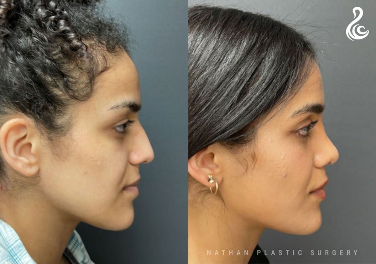 Rhinoplasty Before & After Gallery - Patient 131783 - Image 2