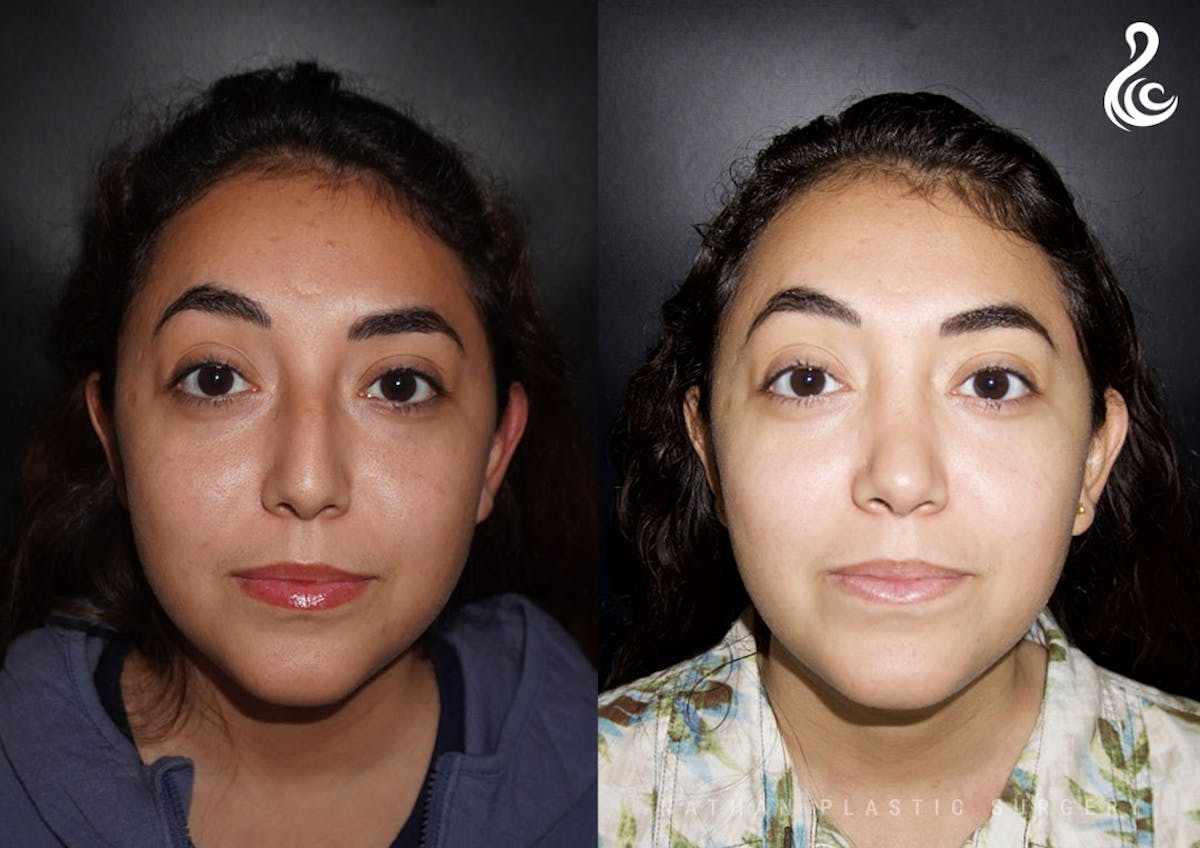 Rhinoplasty Before & After Gallery - Patient 304526 - Image 3