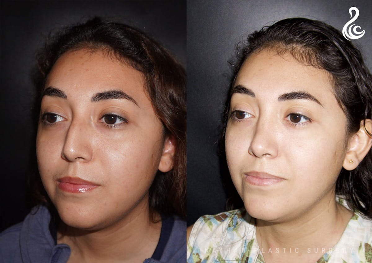 Rhinoplasty Before & After Gallery - Patient 304526 - Image 4