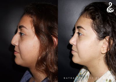 Rhinoplasty Before & After Gallery - Patient 304526 - Image 1