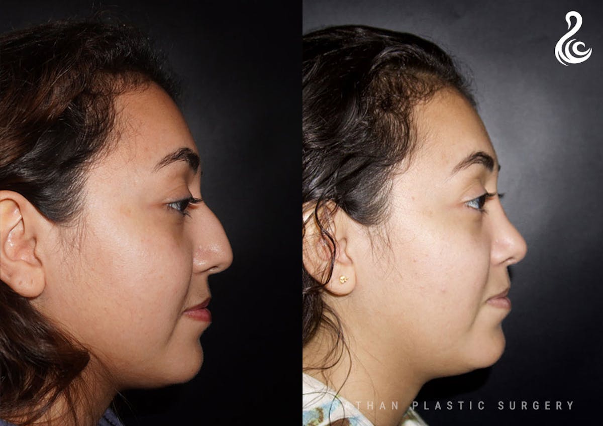 Rhinoplasty Before & After Gallery - Patient 304526 - Image 2