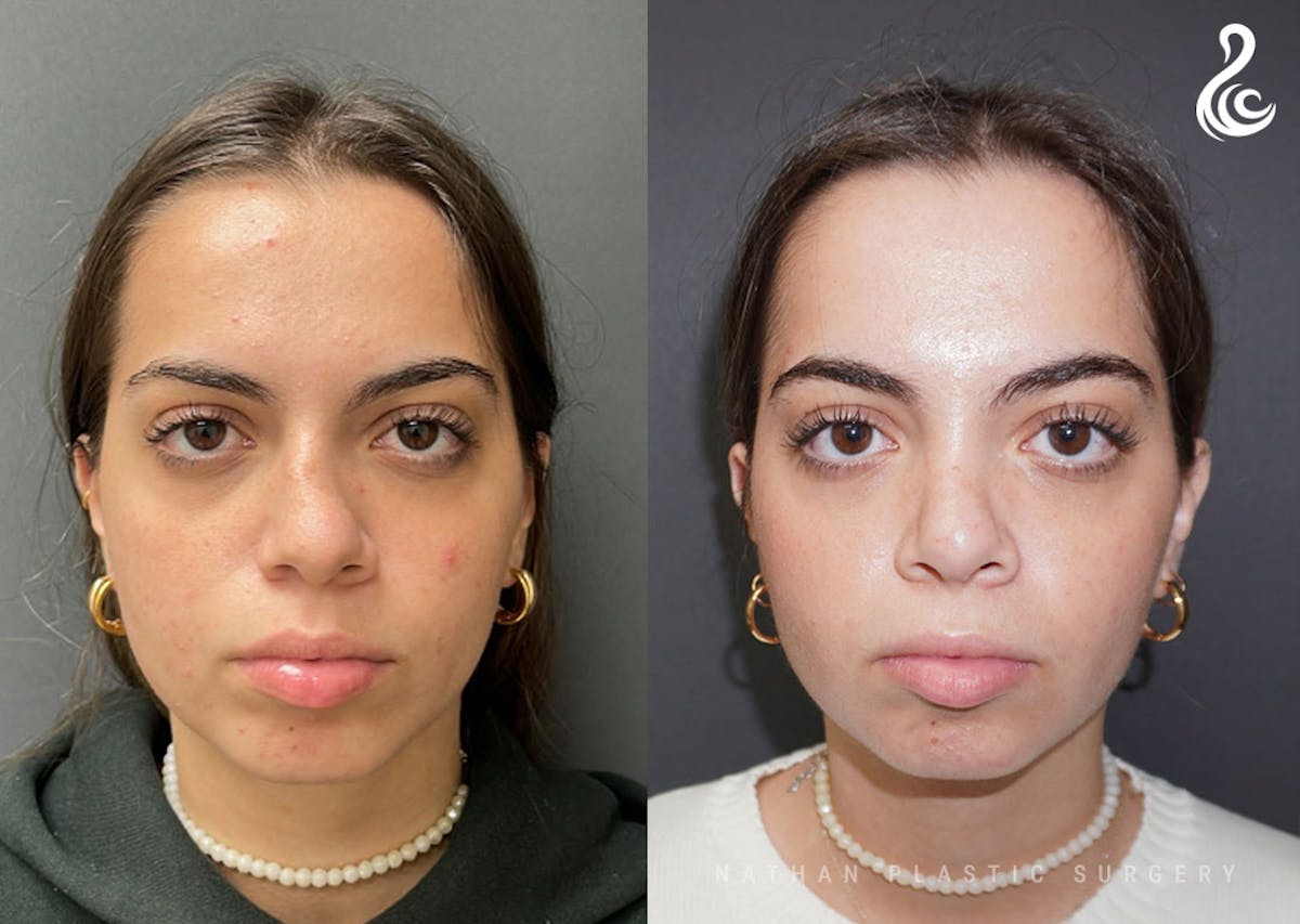 Rhinoplasty Before & After Gallery - Patient 199994 - Image 3