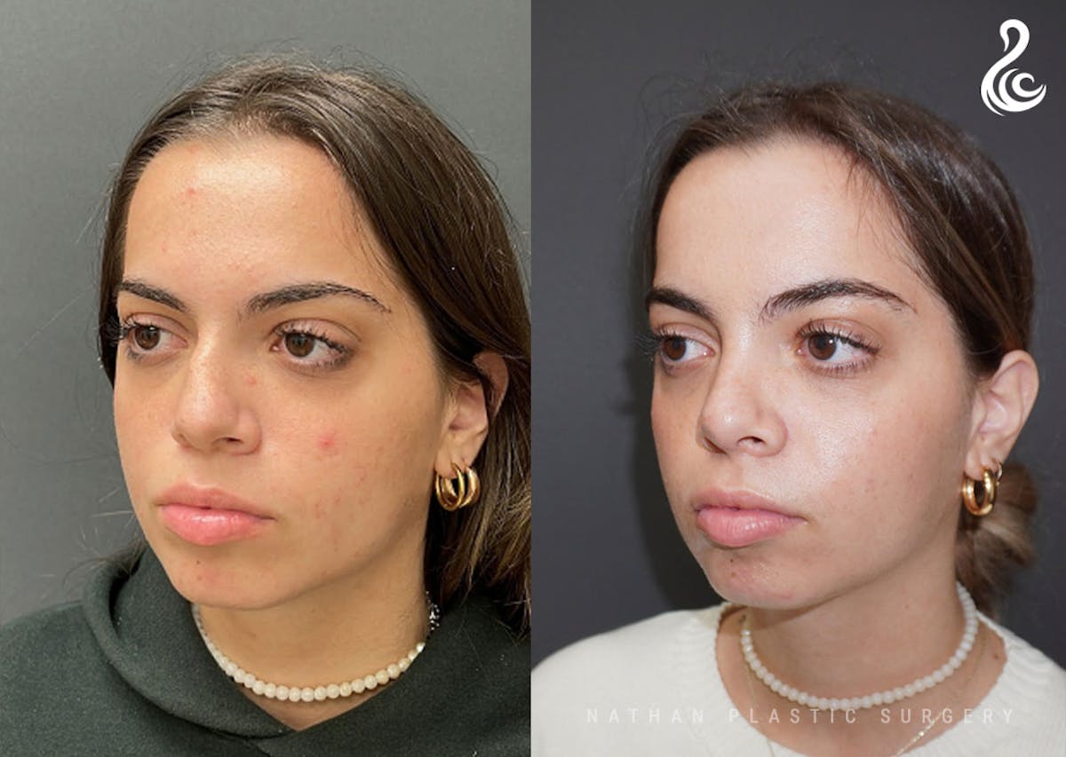 Rhinoplasty Before & After Gallery - Patient 199994 - Image 4