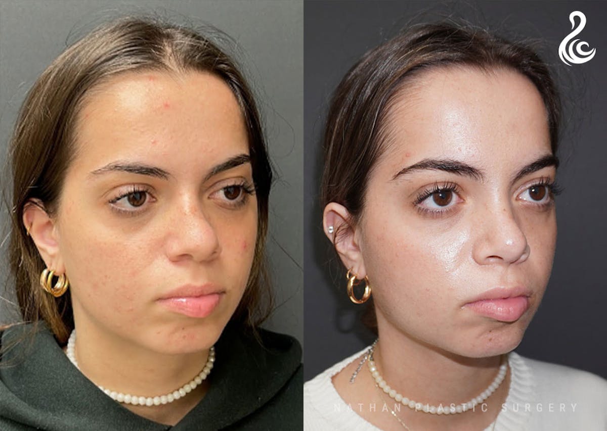 Rhinoplasty Before & After Gallery - Patient 199994 - Image 5