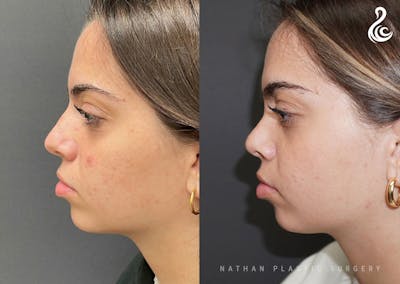 Rhinoplasty Before & After Gallery - Patient 199994 - Image 1