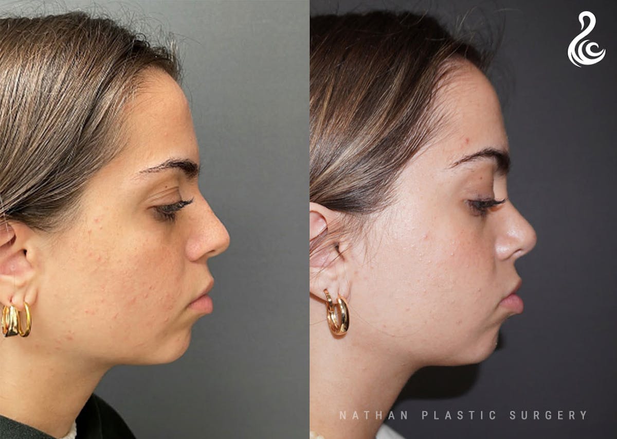 Rhinoplasty Before & After Gallery - Patient 199994 - Image 2