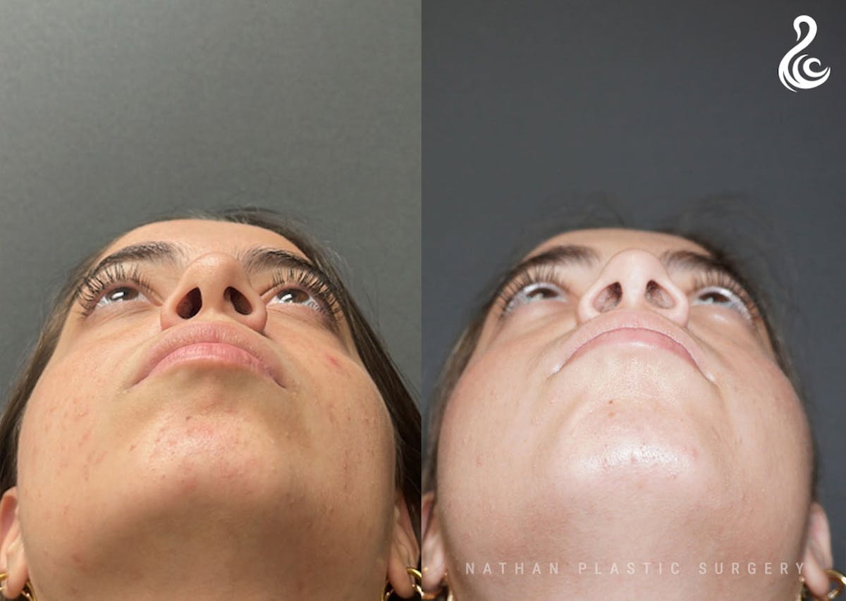 Rhinoplasty Before & After Gallery - Patient 199994 - Image 6