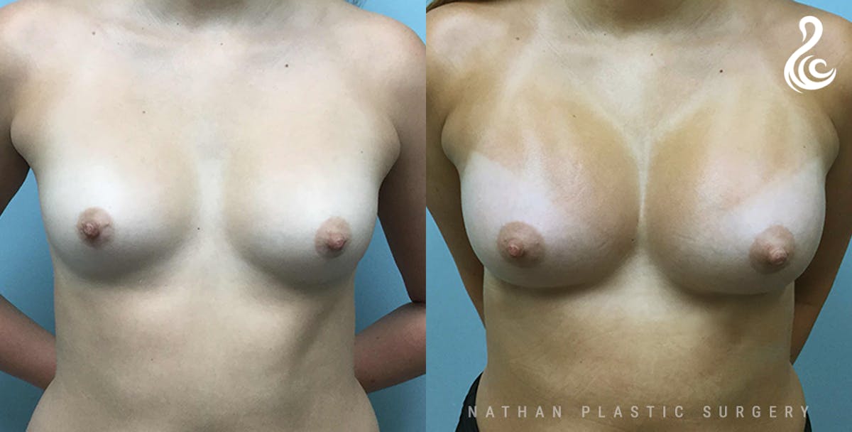 Breast Augmentation Before & After Gallery - Patient 305719 - Image 1