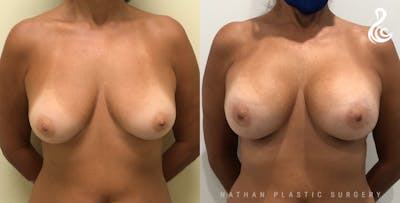 Breast Augmentation Before & After Gallery - Patient 308972 - Image 1