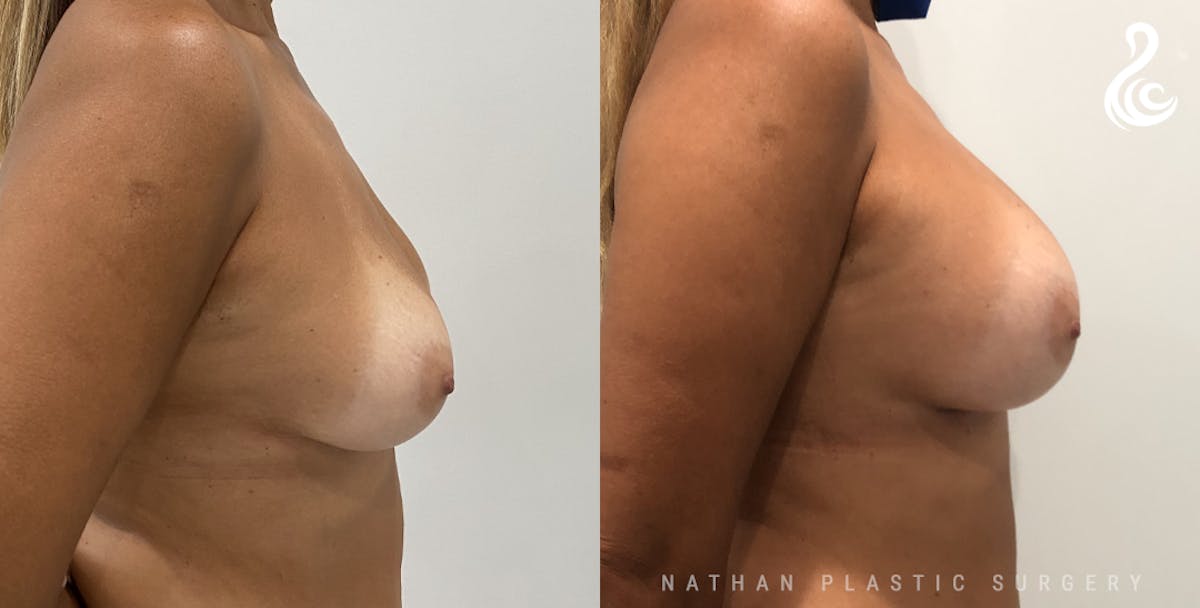 Breast Augmentation Before & After Gallery - Patient 308972 - Image 2