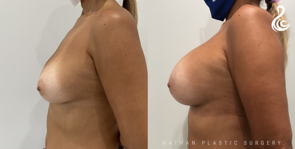 Breast Augmentation Before & After Gallery - Patient 308972 - Image 3