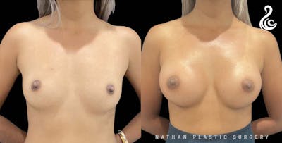 Breast Augmentation Before & After Gallery - Patient 303810 - Image 1