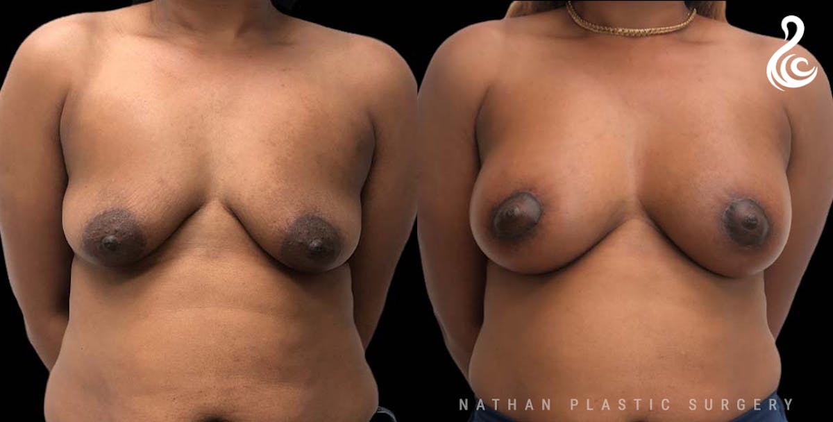 Breast Augmentation Before & After Gallery - Patient 713522 - Image 1