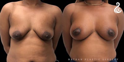 Breast Augmentation Before & After Gallery - Patient 713522 - Image 1