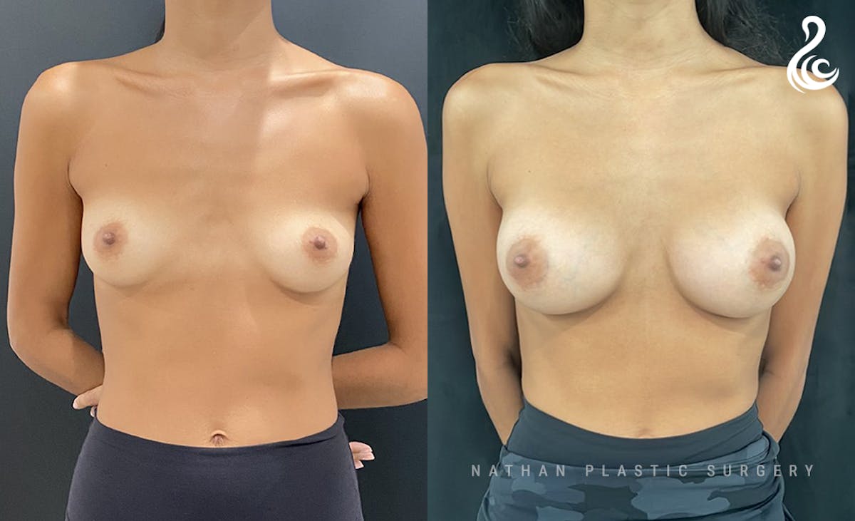 Breast Augmentation Before & After Gallery - Patient 121288 - Image 1