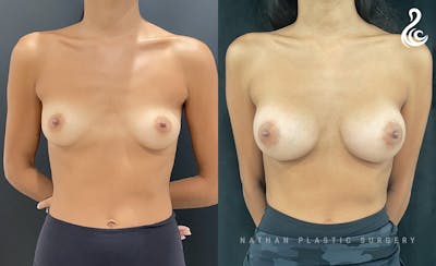 Breast Augmentation Before & After Gallery - Patient 121288 - Image 1