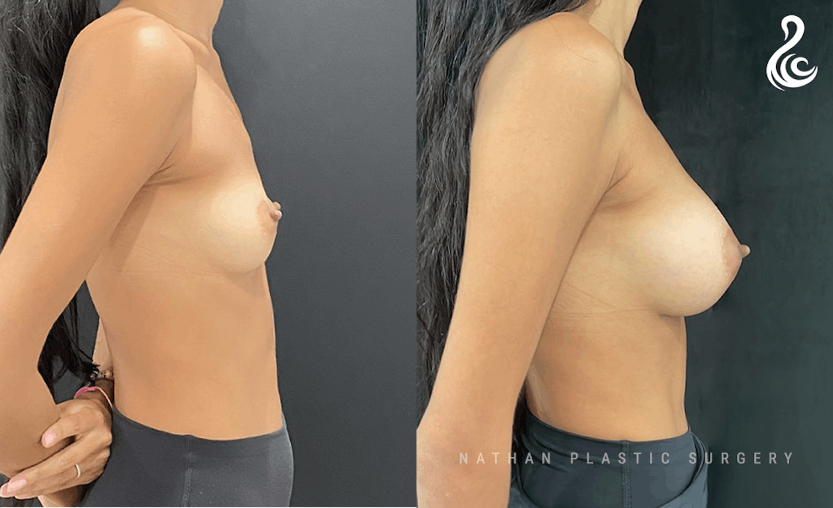 Breast Augmentation Before & After Gallery - Patient 121288 - Image 2