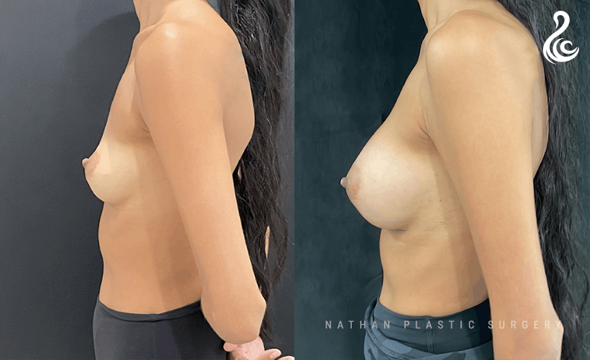 Breast Augmentation Before & After Gallery - Patient 121288 - Image 3