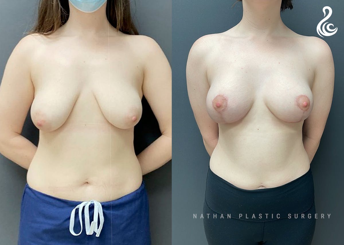 Breast Augmentation Before & After Gallery - Patient 159960 - Image 1