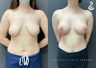 Breast Augmentation Before & After Gallery - Patient 159960 - Image 1