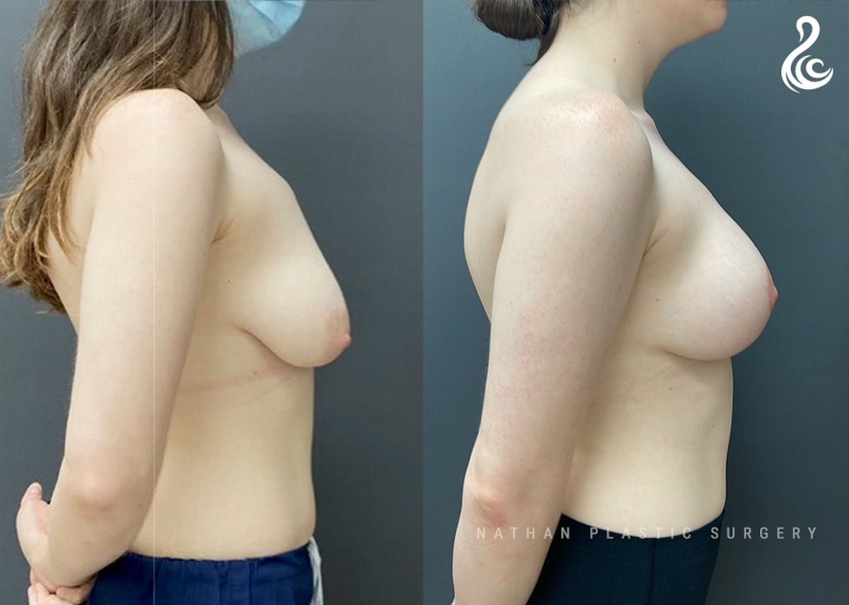 Breast Augmentation Before & After Gallery - Patient 159960 - Image 2