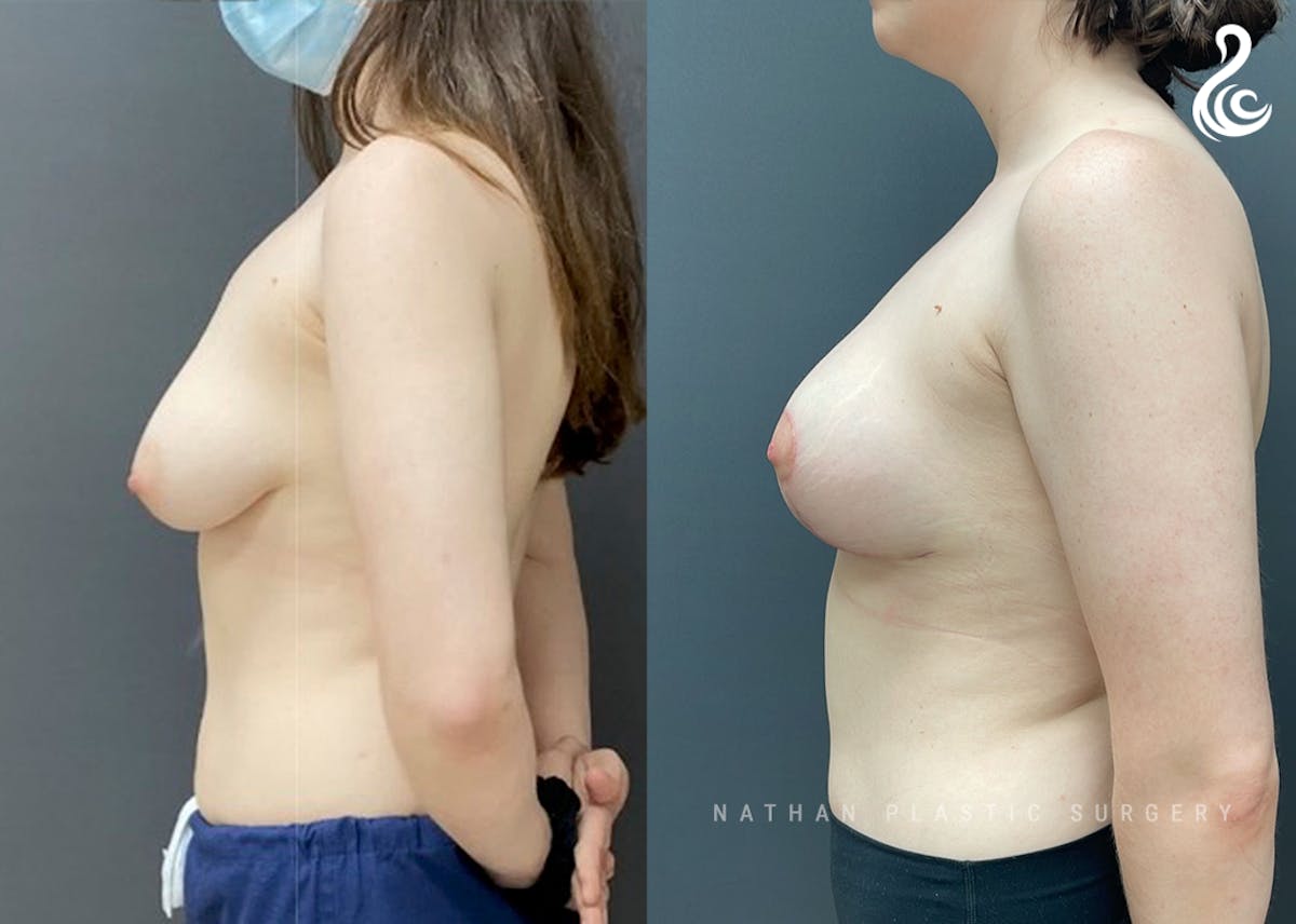 Breast Augmentation Before & After Gallery - Patient 159960 - Image 3