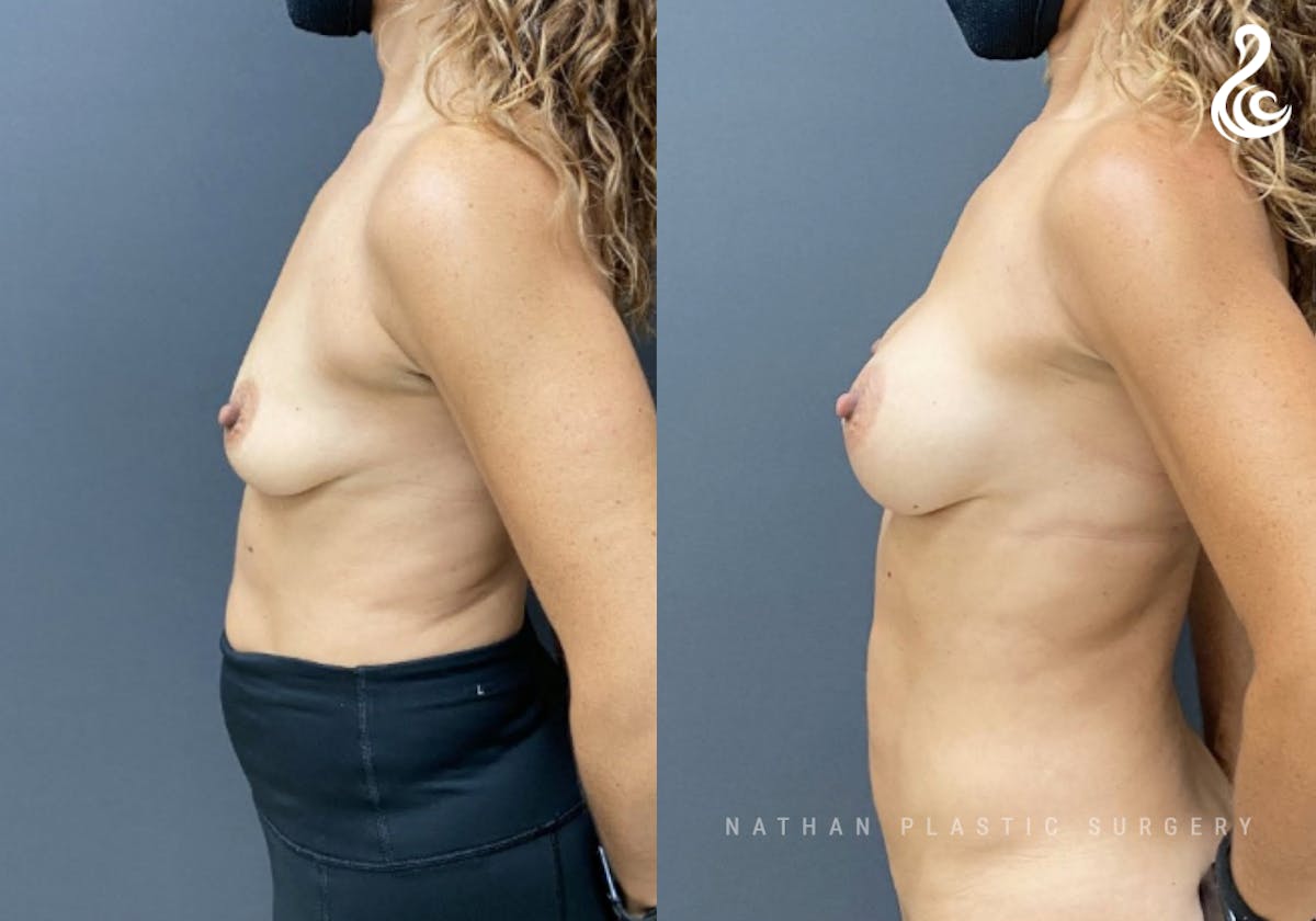Breast Augmentation Before & After Gallery - Patient 171927 - Image 3