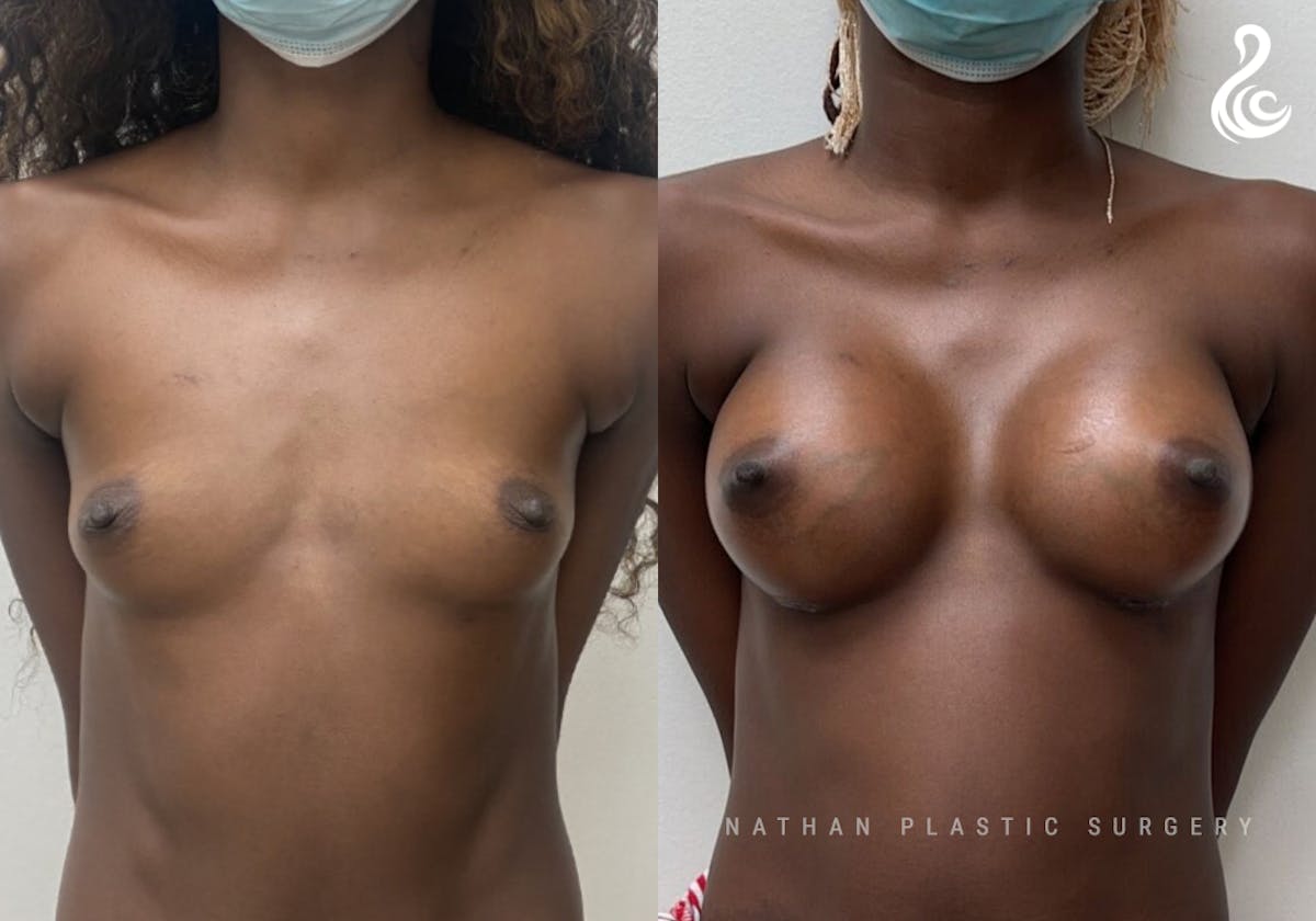 Breast Augmentation Before & After Gallery - Patient 274013 - Image 1