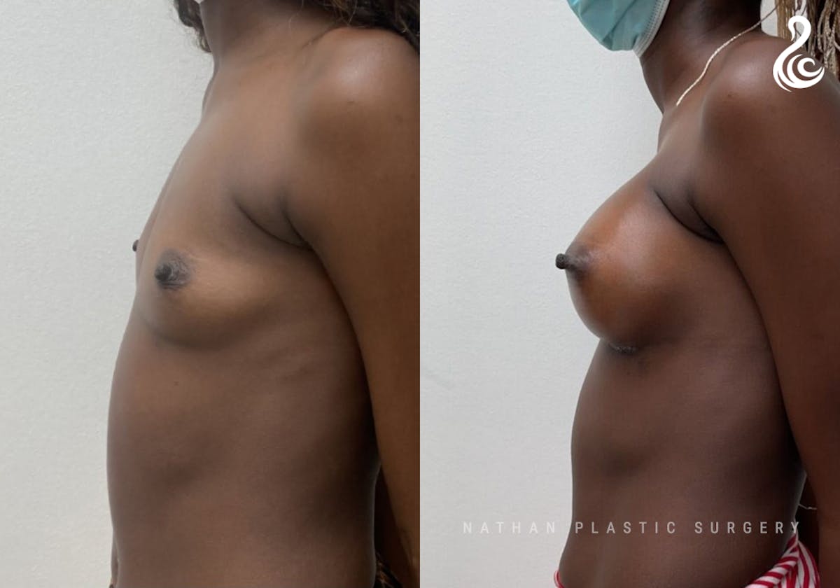 Breast Augmentation Before & After Gallery - Patient 274013 - Image 3