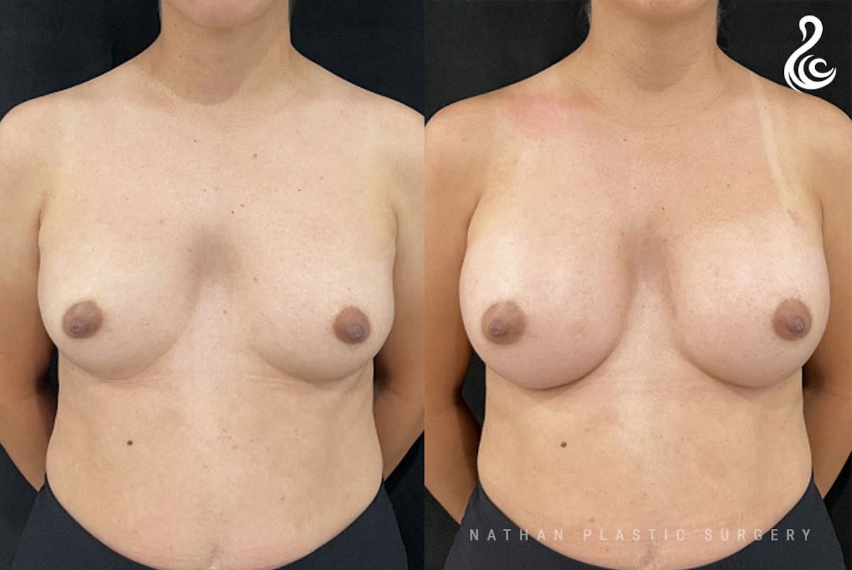 Breast Augmentation Before & After Gallery - Patient 383744 - Image 1