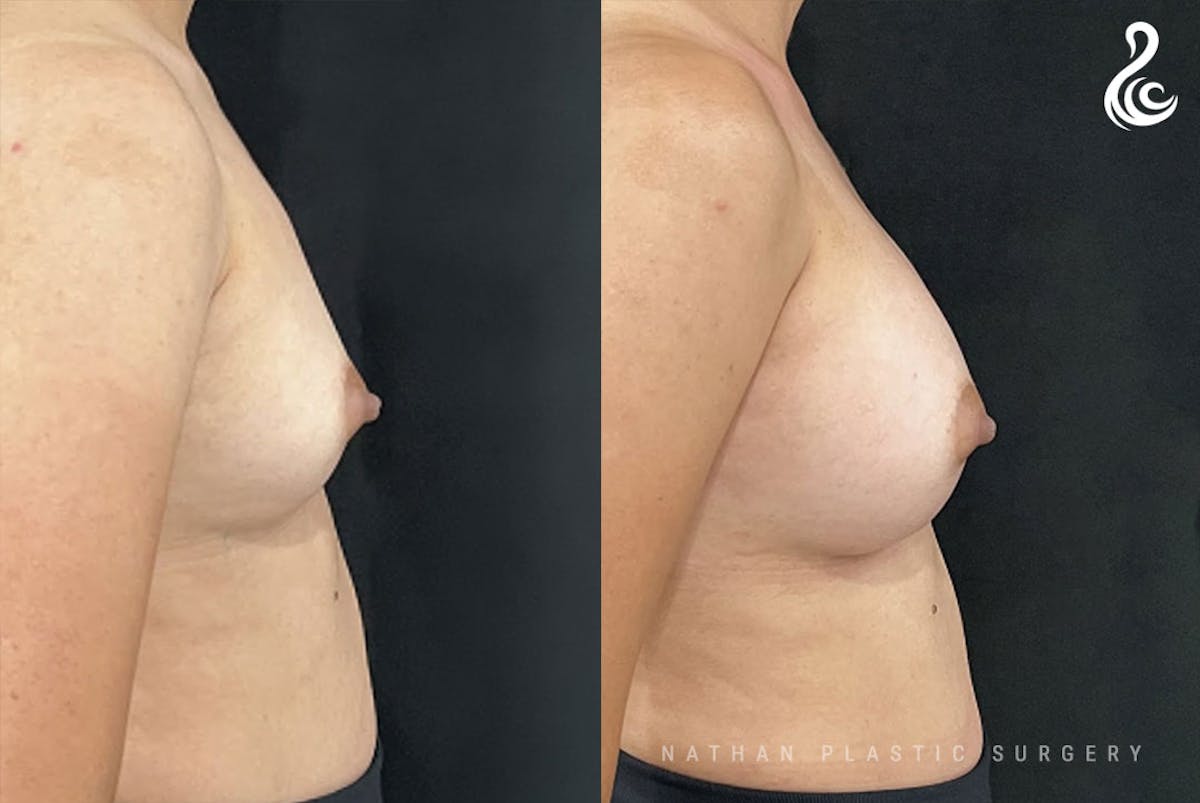 Breast Augmentation Before & After Gallery - Patient 383744 - Image 2