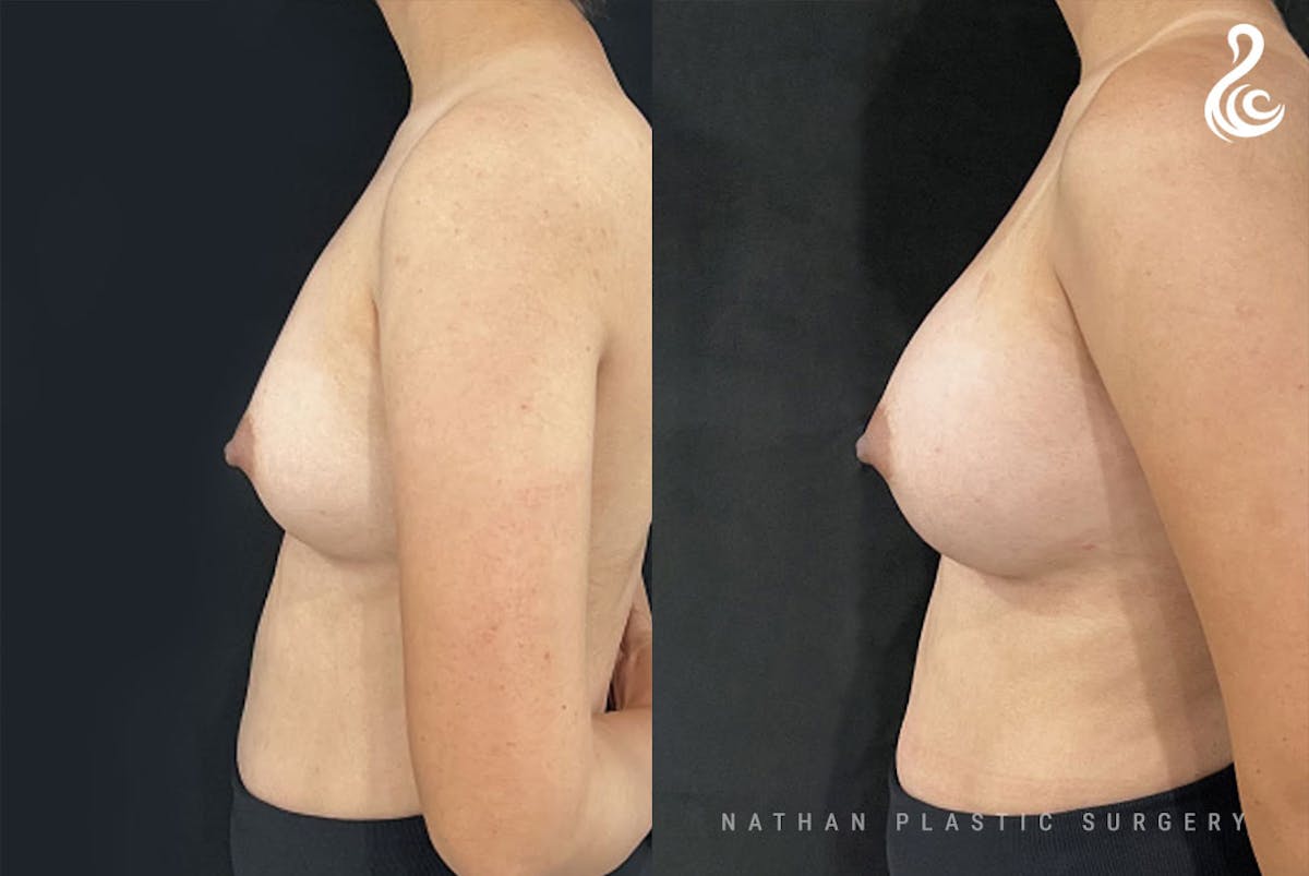 Breast Augmentation Before & After Gallery - Patient 383744 - Image 3