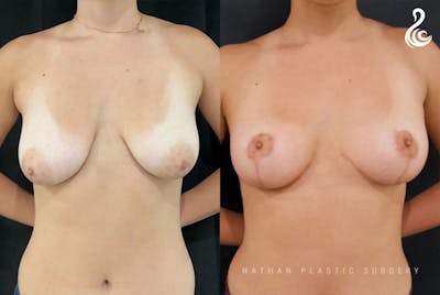 Breast Lift Before & After Gallery - Patient 108997 - Image 1
