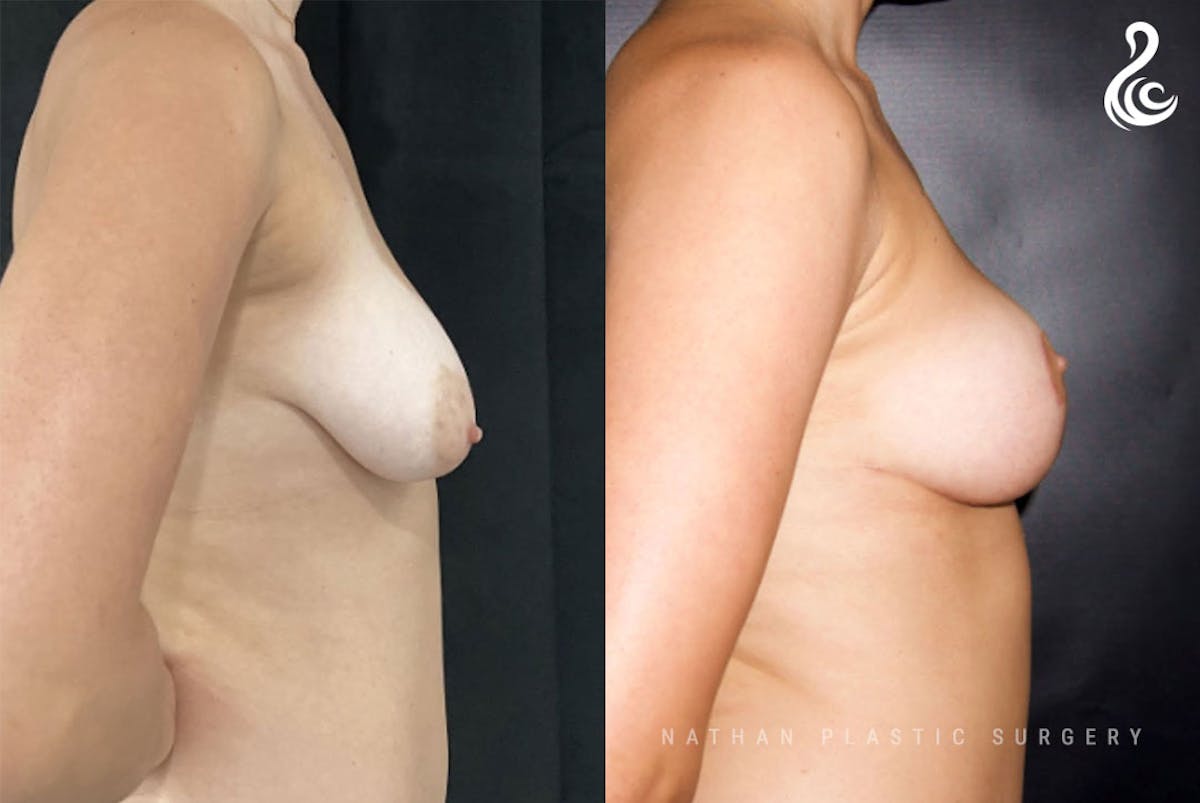 Breast Lift Before & After Gallery - Patient 108997 - Image 2