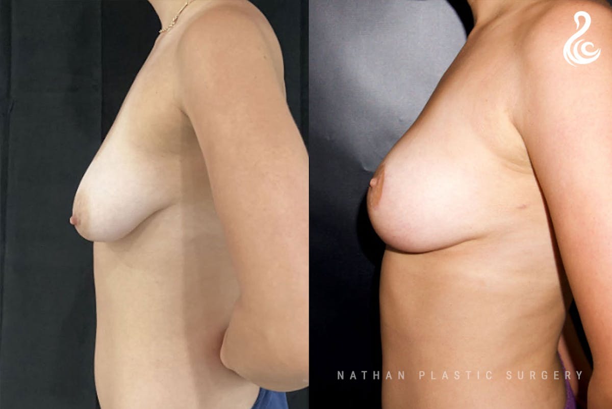 Breast Lift Before & After Gallery - Patient 108997 - Image 3