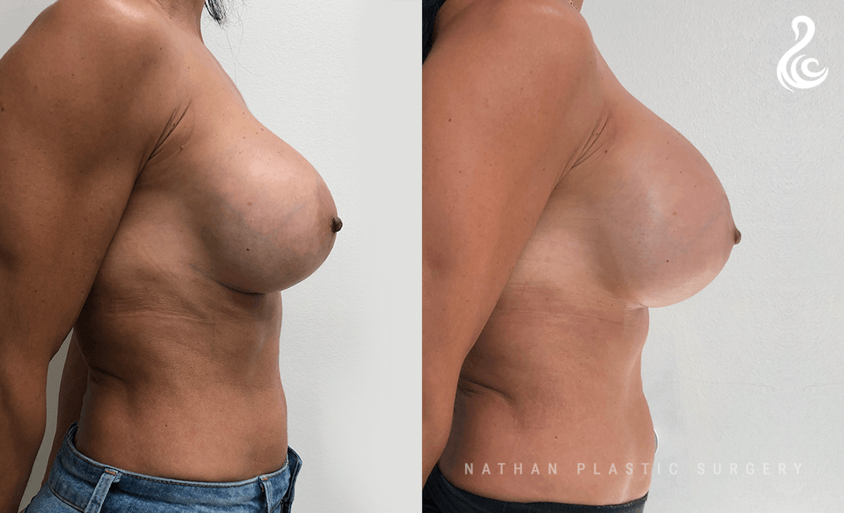 Breast Revision Before & After Gallery - Patient 150507 - Image 2