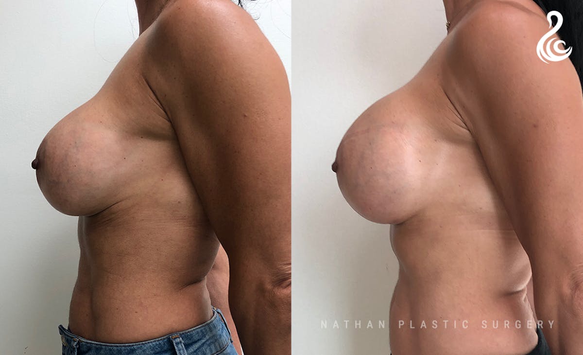 Breast Revision Before & After Gallery - Patient 150507 - Image 3