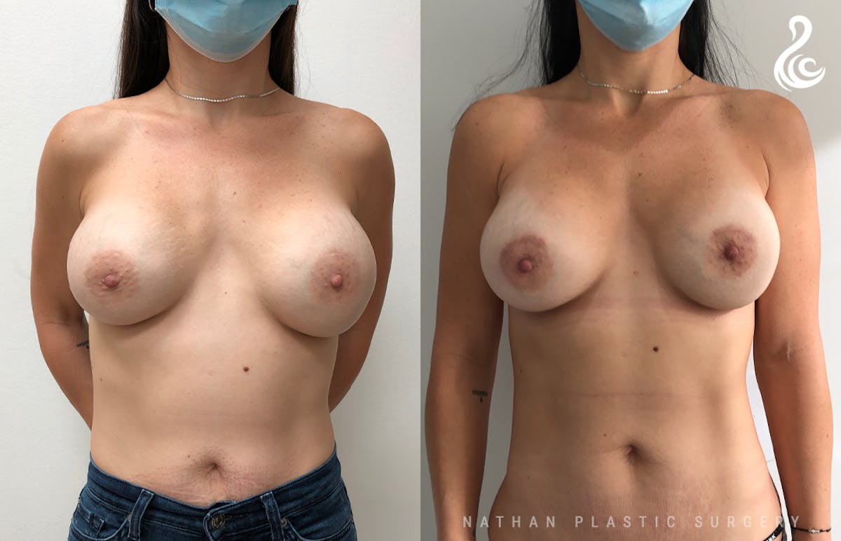 Breast Revision Before & After Gallery - Patient 262579 - Image 1